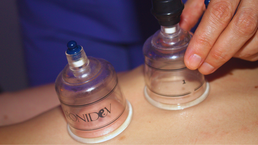 Coppettazione: un’antica tecnica per il benessere del corpo